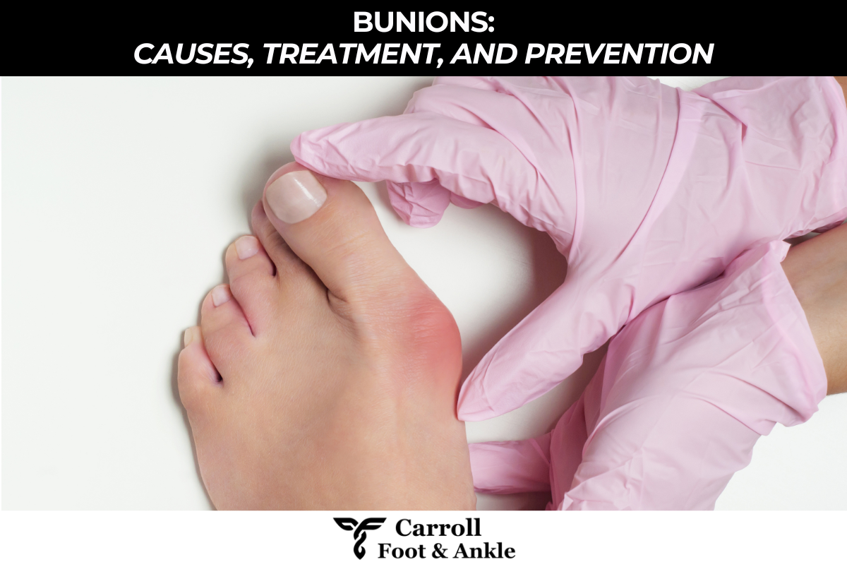 Bunions Causes, Treatment, and Prevention