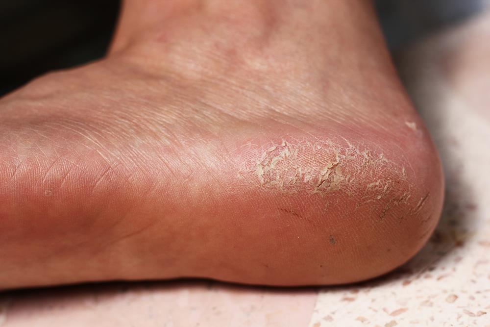 Calluses  Clarkston, MI 