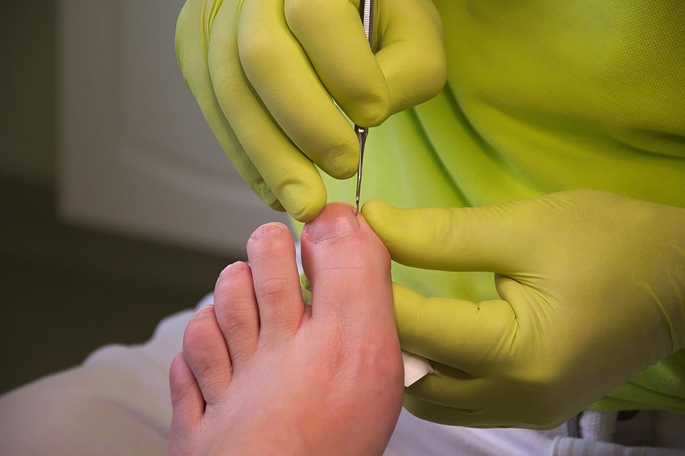 Ingrown Toenails  Clarkston, MI 