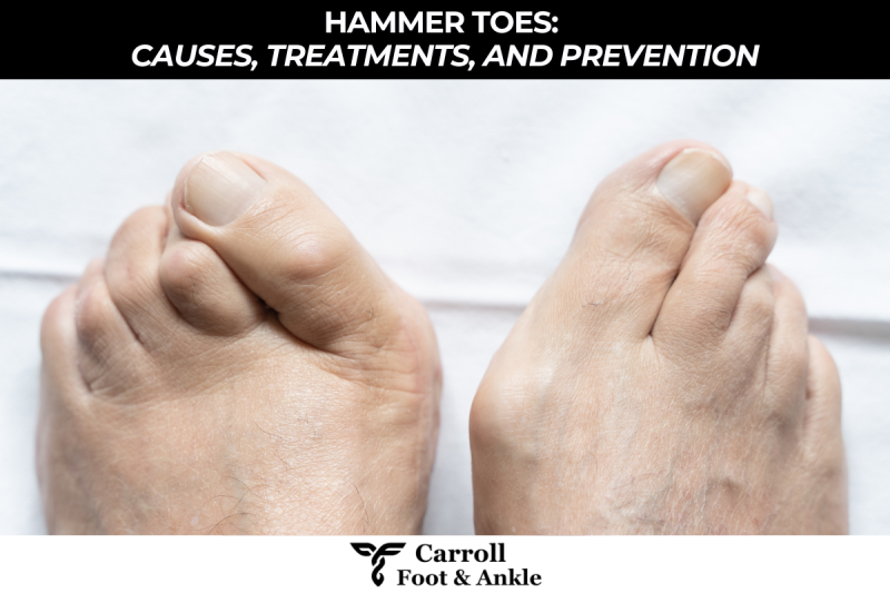 Hammer Toes Causes, Treatments, and Prevention