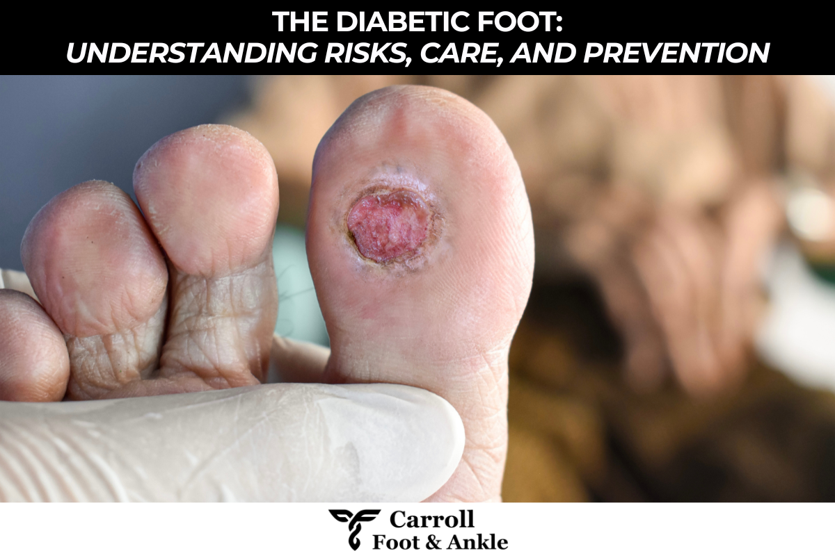 The Diabetic Foot: Understanding Risks, Care, and Prevention