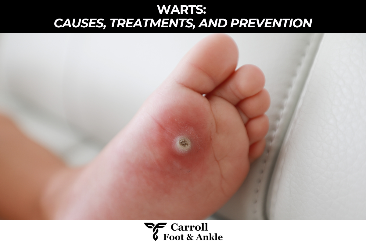 Warts: Causes, Treatments, and Prevention